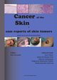 Cancer of the Skin - case reports of skin tumors, Piotr Brzezinski